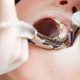 dental extraction